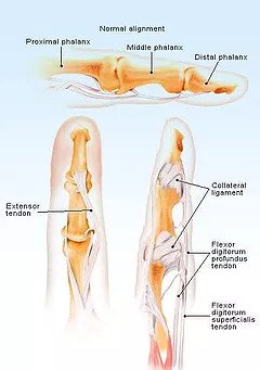 Broken Finger vs Jammed Finger: How to Tell the Difference