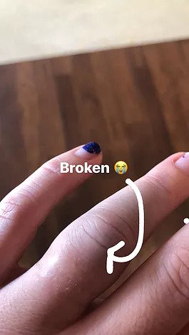 broken middle finger