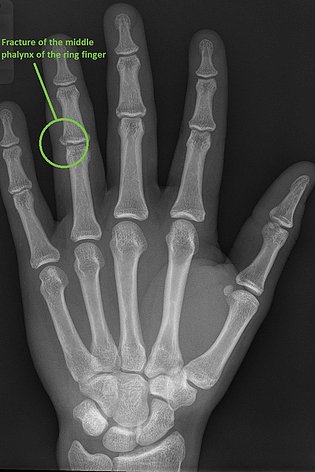 broken hand xray