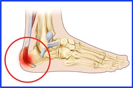 Pain at the base of the achilles on sale tendon