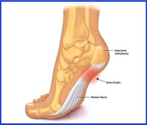 Heel Pain - Activate Physiotherapy