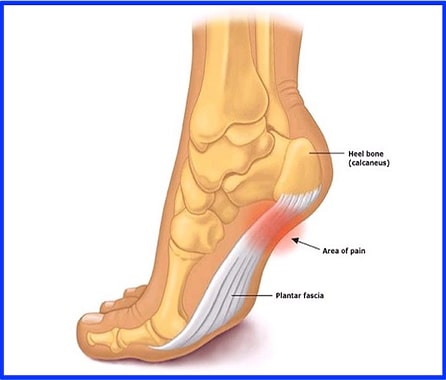 Plantar Fasciitis Foot Pain - Activate Physiotherapy