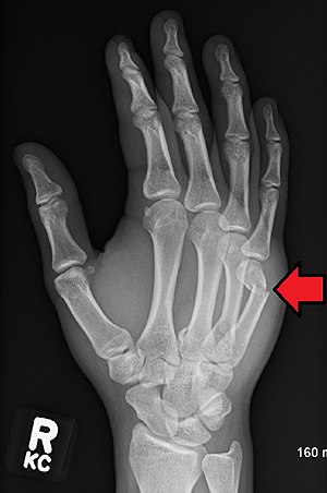 5th metacarpal neck fracture icd 10