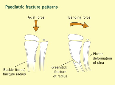 buckle fracture radius