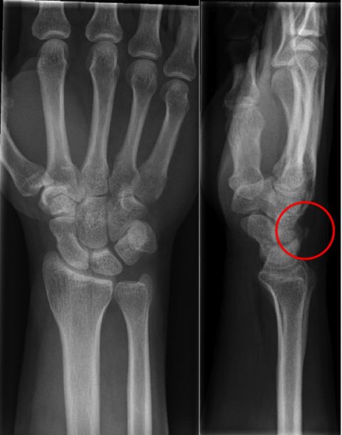 Triquetral Fracture - Activate Physiotherapy