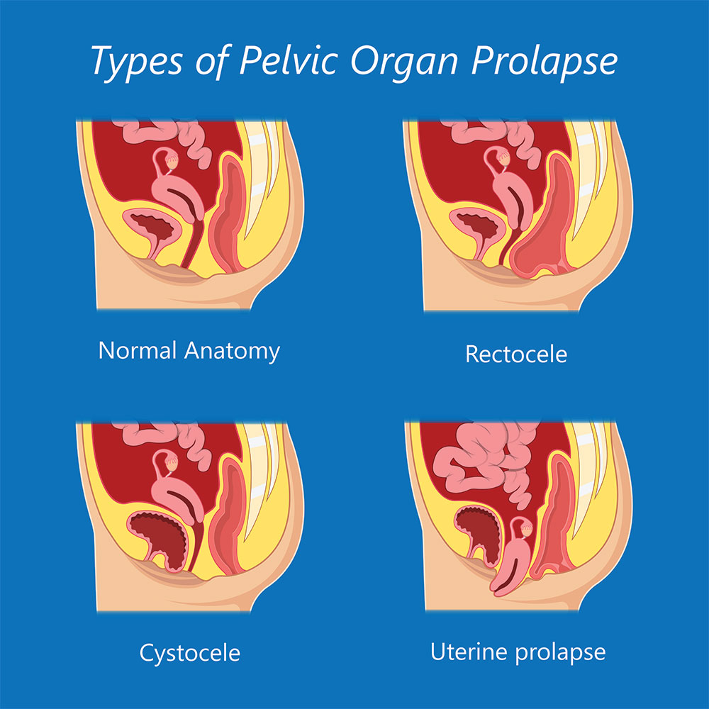 Types of pelvic organ prolapse