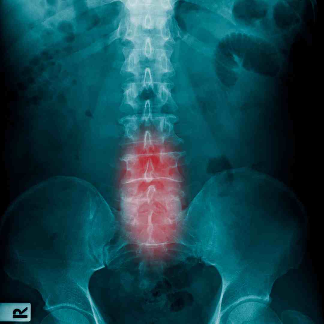 lumbar spine xray